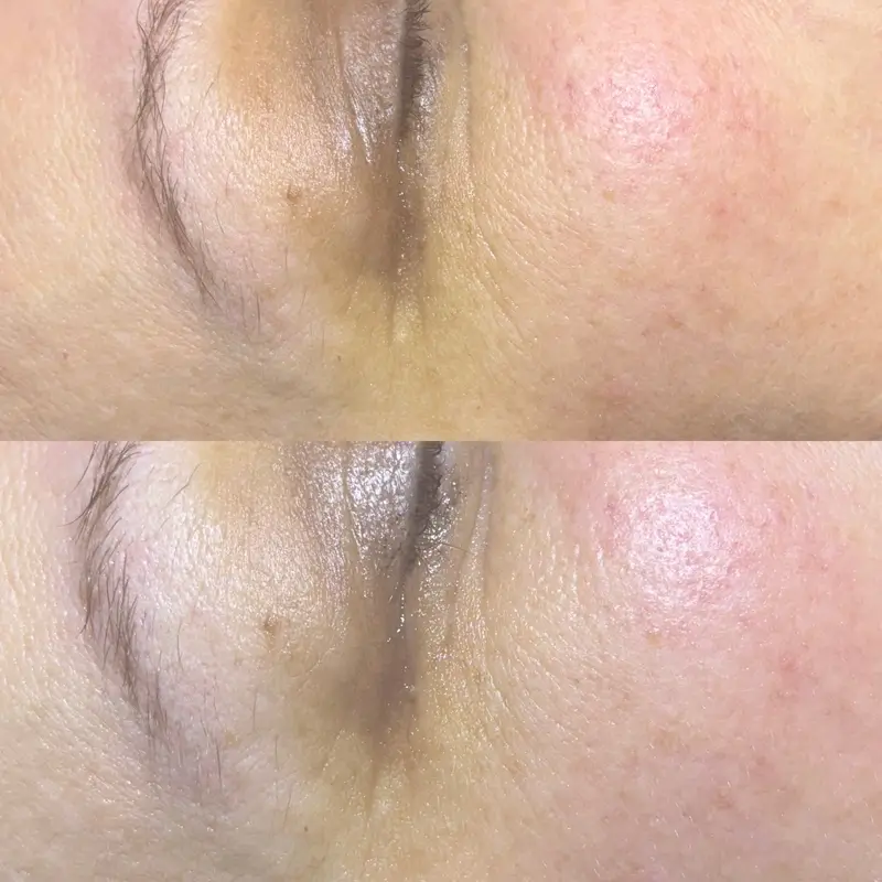 Before-After 10