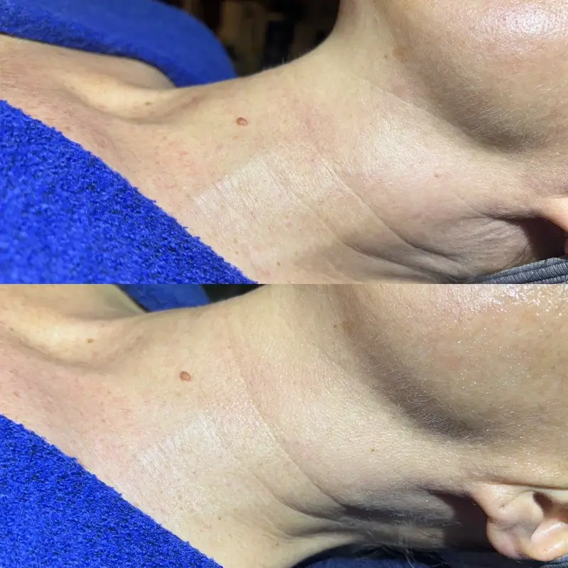 Before-After 13