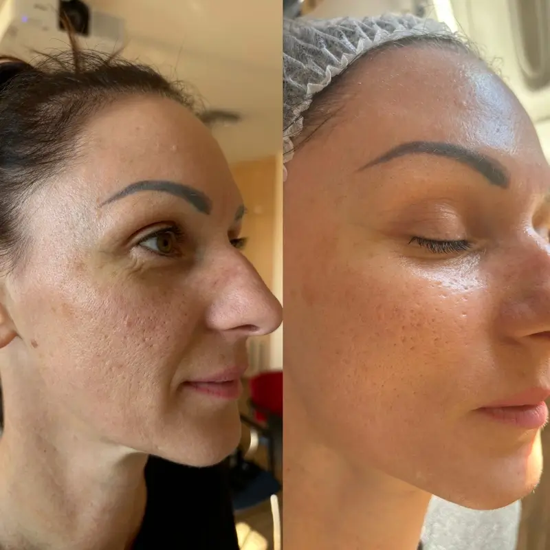 Before-After 15